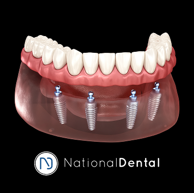 Zirconia Implant Bridge